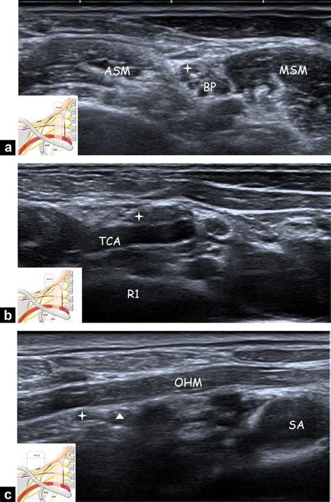 Ultrasonography Of The Cervical Portion Of The Ssn A Area 1 Axial