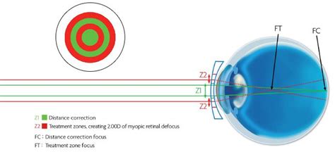 Coopervision Misight Contact Lenses A Breakthrough In Myopia Control