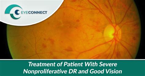 Treatment of Patient With Severe Nonproliferative DR and Good Vision