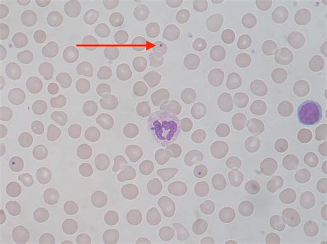 Sickle Cell Anemia - Hematology - Medbullets Step 1