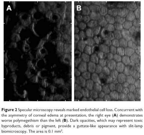 Clinical And Genetic Investigation Of Amantadine Associated Corneal Ed