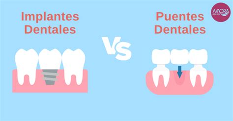 Diferencia Implantes Dentales Puentes Sabadell