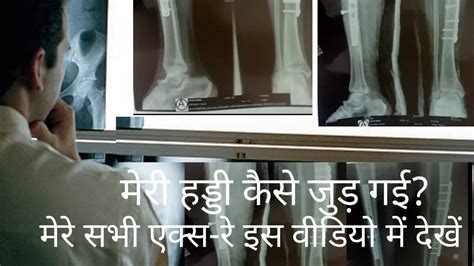 Tibia Fibula Fracture Recovery मेरी हड्डी कैसे जुड़ गई मेरे सभी