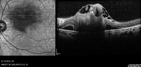 The Full Thickness Appearance Of The Retinal Metastasis Is Seen In Download Scientific Diagram