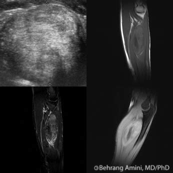 Roentgen Ray Reader Solitary Fibrous Tumor Of The Soft Tissues