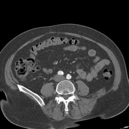 Bilateral delayed nephrogram from renal artery stenosis | Radiology Case | Radiopaedia.org