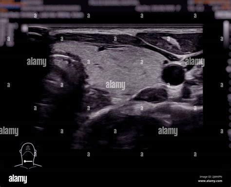 Ultrasonography Of Thyroid Gland For Diagnostics Of The Thyroid Gland