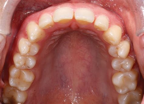 Smile Enhancement In The Most Conservative Fashion An Orthodontic