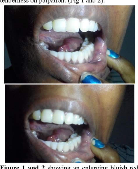 Figure 1 From Arterio Venous Malformation Of Tongue A Case Report