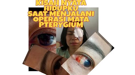 Pengalaman Hidup Operasi Mata Pterygium Youtube