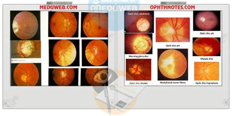 Common optic disc signs and it’s DD - Meduweb