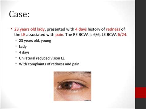 Bacterial keratitis | PPT