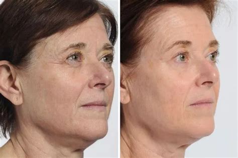 Shoppers Rave About NIRA Pro Laser For Youthful Skin Here S How To