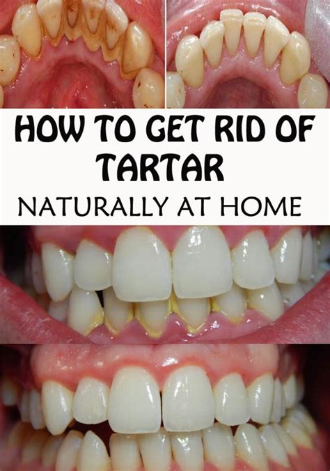 How to Get Rid of Tooth Tartar Naturally at Home - Everything in one place