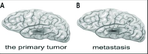 Difference Between Primary And Secondary Tumor In A Tumor Is Shown