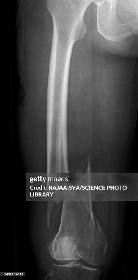 Comminuted Fracture X Ray