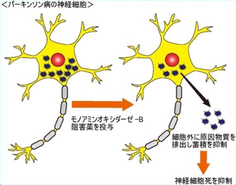 既存のパーキンソン病症状改善薬に パーキンソン病の進行抑制につながる作用を発見 学校法人 大阪医科薬科大学