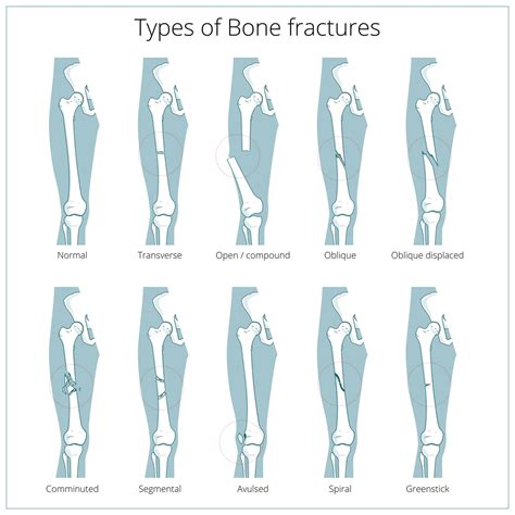 Types of bone fracture - serviceseka