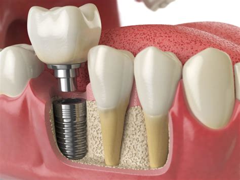 Implantes Dentales Para Personas Mayores En Thousand Oaks