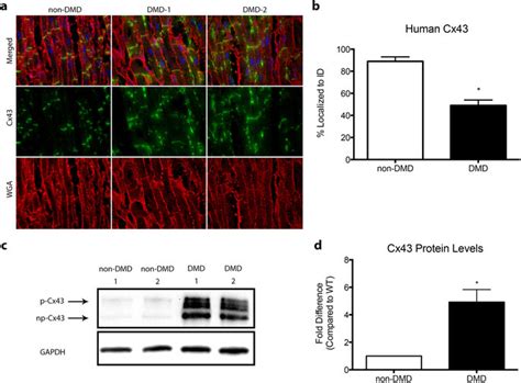 Human Dmd Hearts Show Altered Cx43 Localization And Expression A