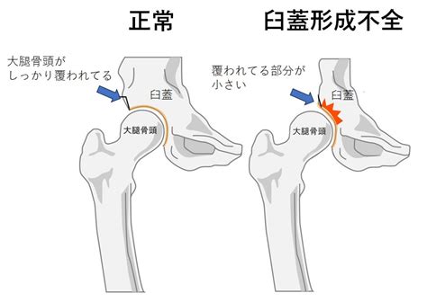 変形性股関節症 慢性痛治療の専門医による痛みと身体のq＆a