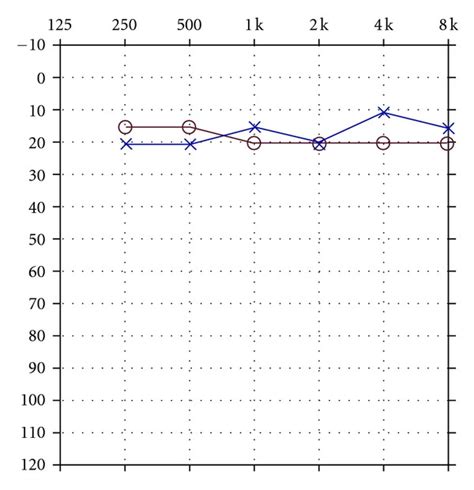 Audiogram Depicting Normal Peripheral Auditory Sensitivity For Both Ears Download Scientific