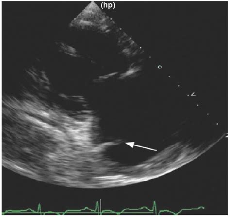 Endocarditis And Other Pathologic And Normal Anatomic Variants Thoracic Key