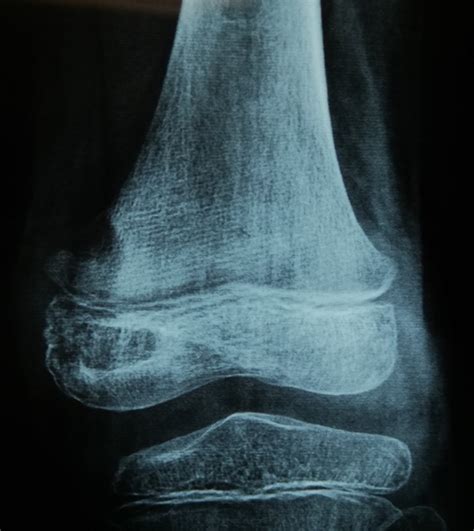 Osteomyelitis Jaw Radiographic Appearance