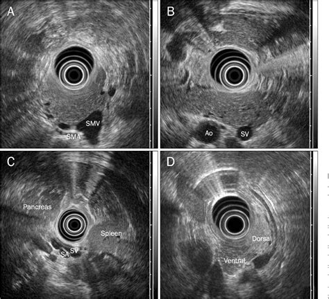 Figure 3 From Polysplenia Syndrome With Congenital Agenesis Of Dorsal Pancreas Presenting As