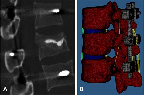 Figure From Biomechanical Effects Of Vertebroplasty On Thoracolumbar