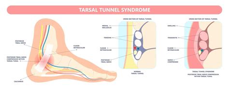 Tarsal Tunnel Syndrome Braces Shoes Symptoms And Treatment