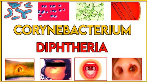 Diphtheria Corynebacterium Diphtheriae Morphology Etiology