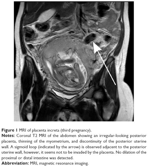 Escalating Placenta Invasiveness Repeated Placenta Accreta At The Lim