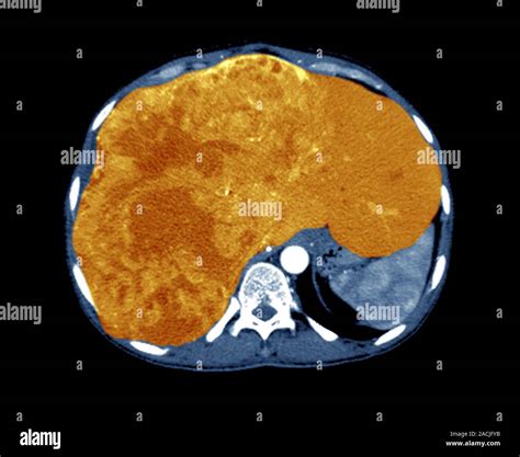 Coloured Computed Tomography Ct Scan In Axial Section Of The Abdomen