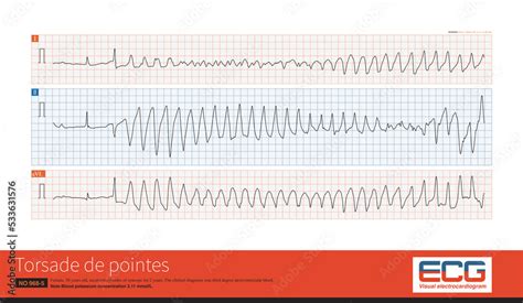 Torsade De Pointes Refers To The Pleomorphic Ventricular Tachycardia