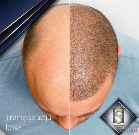 Transplatacije Kose Sapphire Fue Hair Transplant Hair Skin Clinic