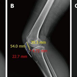 Preoperative Lateral Radiograph Of The Left Knee And Measurement Of The