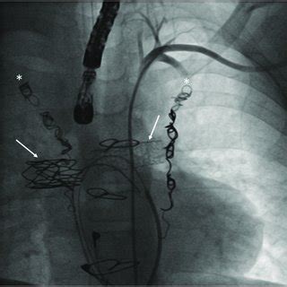 Fenestration Closure Using Vascular Plugs A Lateral Angiogram Of A