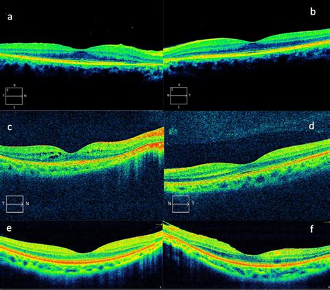 Asymmetric Presentation And Fundus Autofluorescence Findings In Non