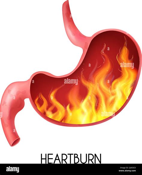 Realistic Human Internal Organ Stomach With Heartburn On White