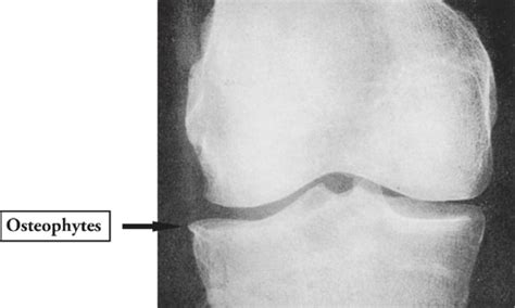 Osteophyte; Bone Spur