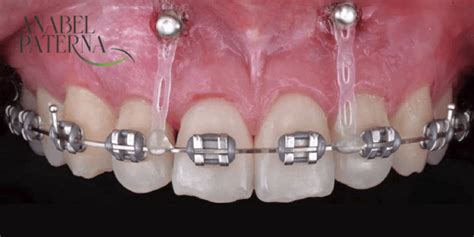Microtornillos En Ortodoncia Anabel Paterna