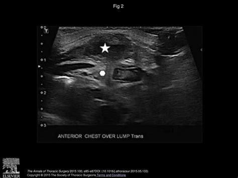 Primary Sternal Osteomyelitis With Extensive Mediastinal Abscess In A