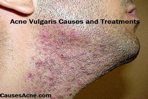 Acne Vulgaris Causes and Treatments - Causes Acne