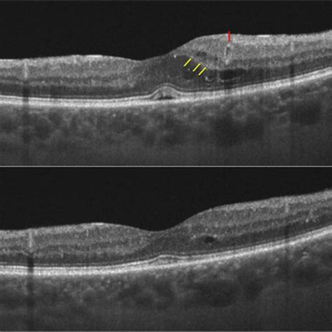 OCT Angiography Parameters Before And After Subthreshold Micropulse