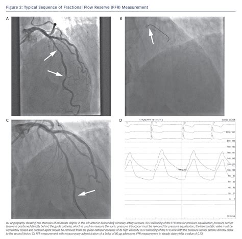 Figure Typical Sequence Of Fractional Flow Reserve Ffr Measurement