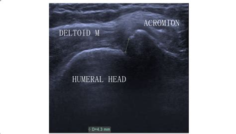 Ultrasound Image Of Ahd In A Shoulder With A Full Thickness Tear Of The