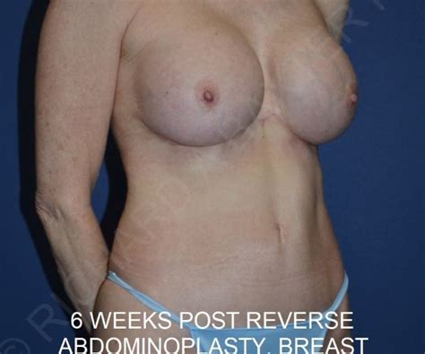 Reverse Tummy Tuck Case Phase Plastic Surgery Dr Baxter