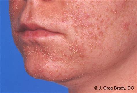 Acne Home Remedies For Dry Skin: Pseudomonas Folliculitis Home Remedies