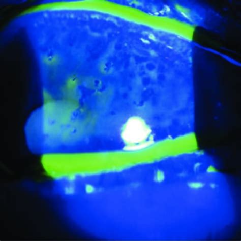 Anterior Segment Photography Of The Patient At First Day Slit Lamp